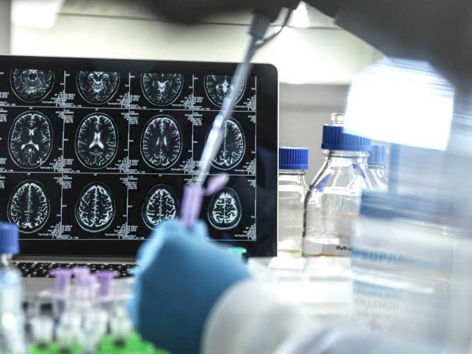 Un fármaco frenó la progresión del Alzheimer un 35% en un ensayo