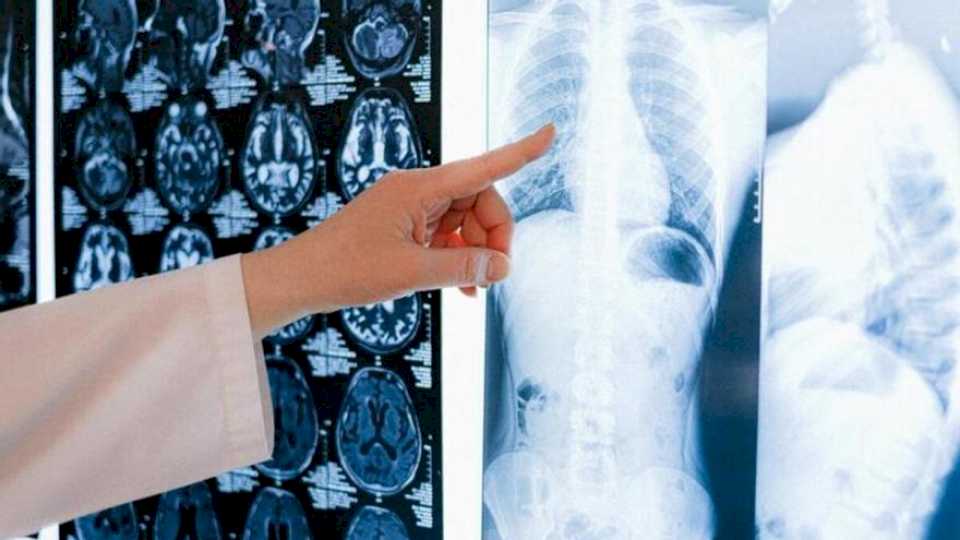 Cáncer de pulmón: los cirujanos torácicos alertan de retrasos en el diagnóstico y hasta el momento de la operación