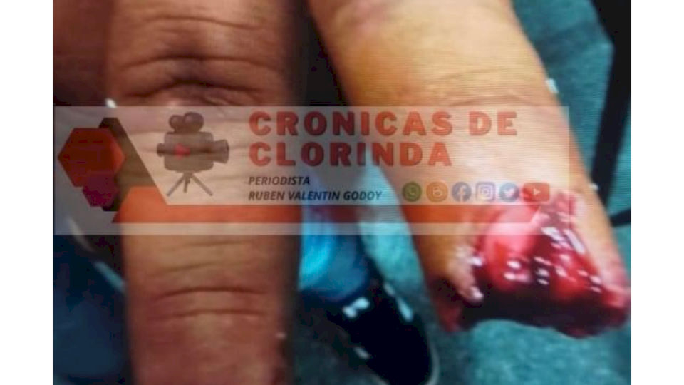 Le arrancó el dedo de un mordisco: el hombre detenido por incidentes en una fiesta, fue denunciado por lesiones gravísimas